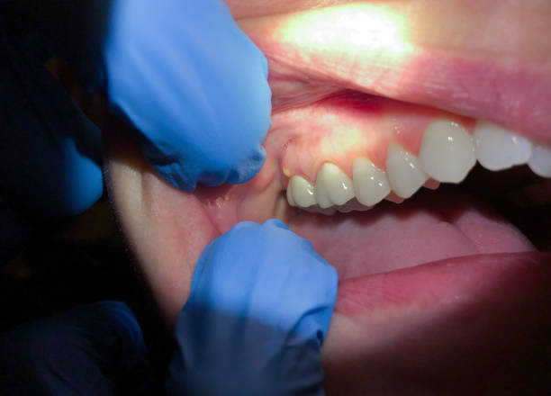 Best Chipped Tooth Repair Near Me  in Mclean, VA